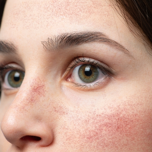Verwijde bloedvaatjes (couperose): oorzaak, verzorging en behandeling voor een rustigere huid