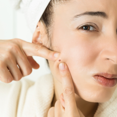 Wat is acne precies
