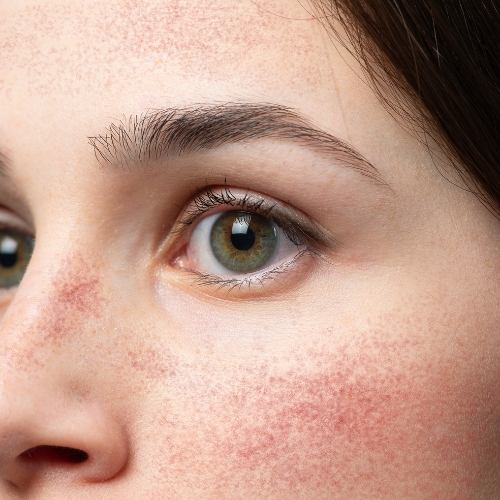 Wat is de huidziekte rosacea