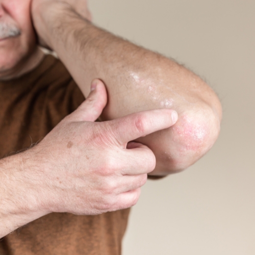 Wat is psoriasis