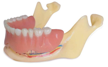 Studienmodell Unterkiefer mit 4 zylindrischen Implantaten