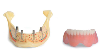 Studienmodell Unterkiefer mit 4 zylindrischen Implantaten