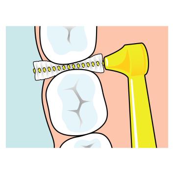 TePe Angle 0,4 mm rosa – 1x6 Stk.