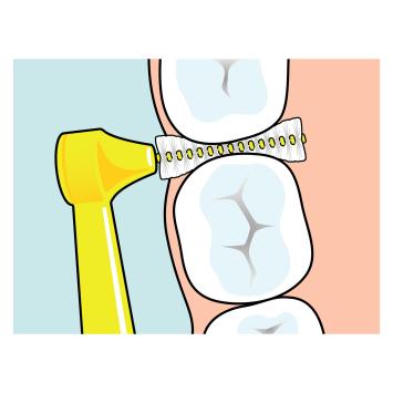 TePe Angle 0,4 mm rosa – 1x6 Stk.