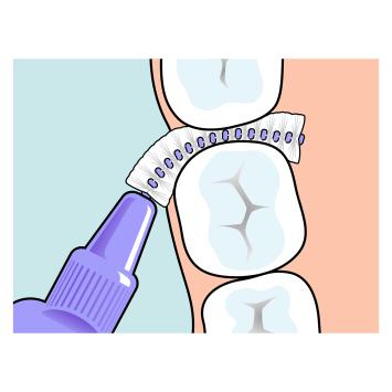 TePe Original Interdentalbürsten 1,10 mm lila – 1x6 Stk.